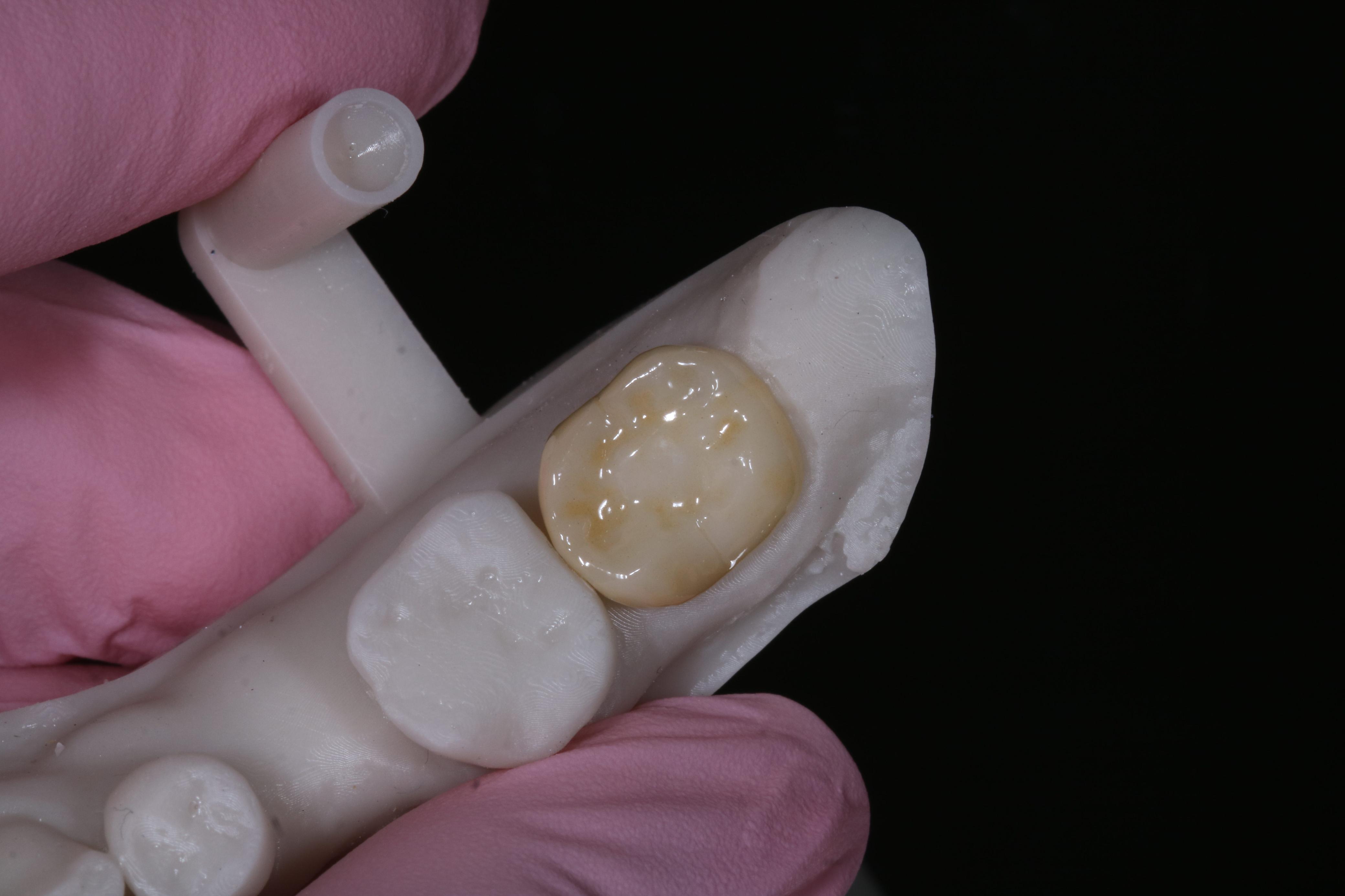 Coroa cerâmica posicionada em modelo de gesso — laboratório Constancio Odontologia